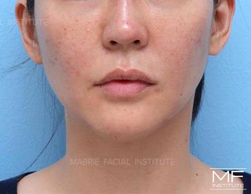 Woman after BOTOX in the Chin (Mentalis BOTOX) treatment.