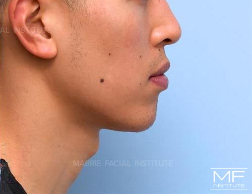 Man after BOTOX in the Chin (Mentalis BOTOX) treatment.