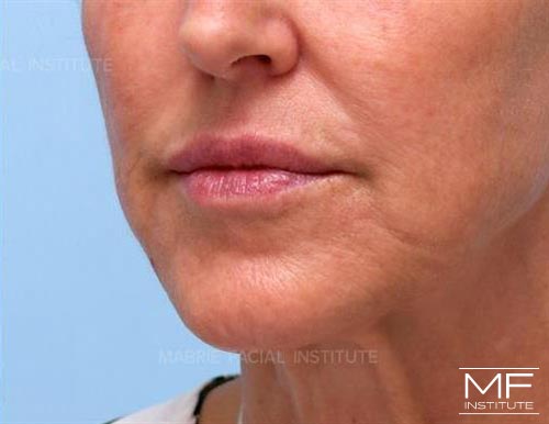 Woman after BOTOX in the Chin (Mentalis BOTOX) treatment.