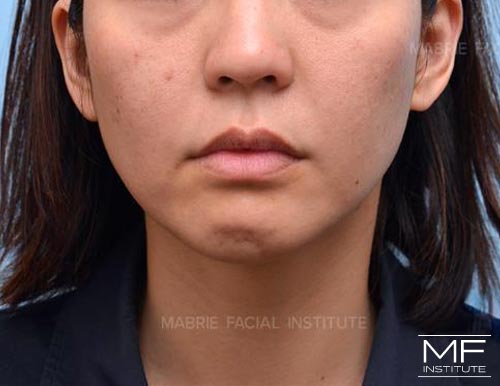 Woman before BOTOX in the Chin (Mentalis BOTOX) treatment.