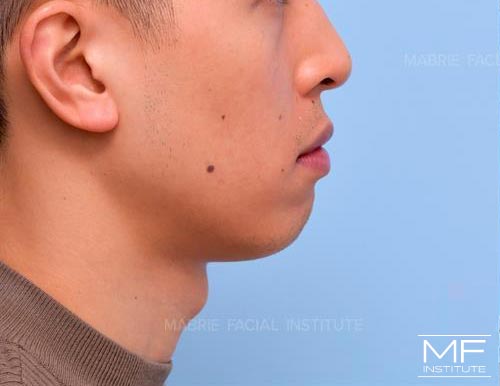 Man before BOTOX in the Chin (Mentalis BOTOX) treatment.