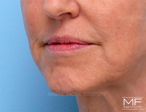 Woman before BOTOX in the Chin (Mentalis BOTOX) treatment.