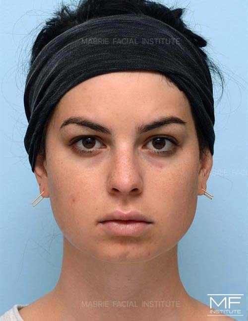 Woman before chin filler treatment.