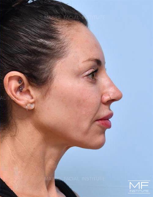 Woman after the Complete Chin and Jawline Filler Package.