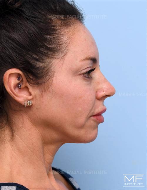 Woman before the Complete Chin and Jawline Filler Package.