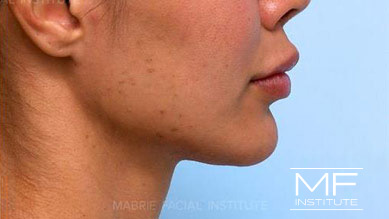 Woman after Dissolving Lip Filler With Hyaluronidase treatment.