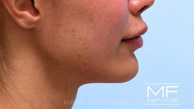 Woman before Dissolving Lip Filler With Hyaluronidase treatment.