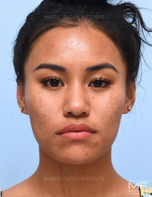 Woman after face slimming with BOTOX.