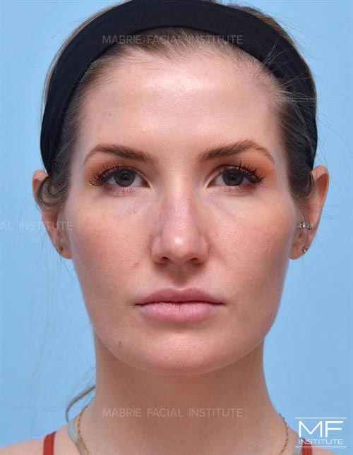 Woman after face slimming with BOTOX.