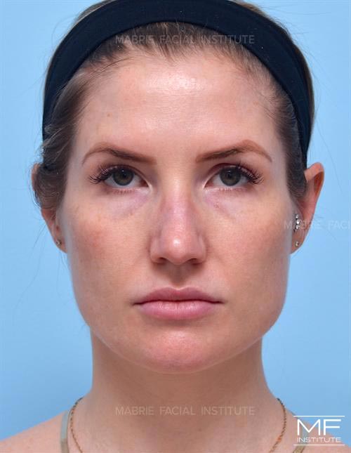 Woman before face slimming with BOTOX.