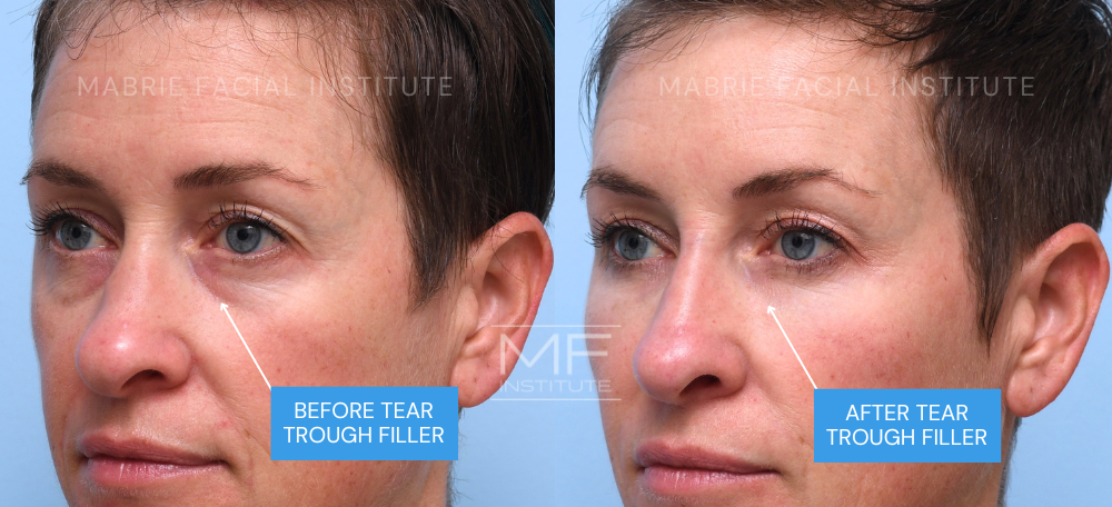 Before and after tear trough filler results case #769