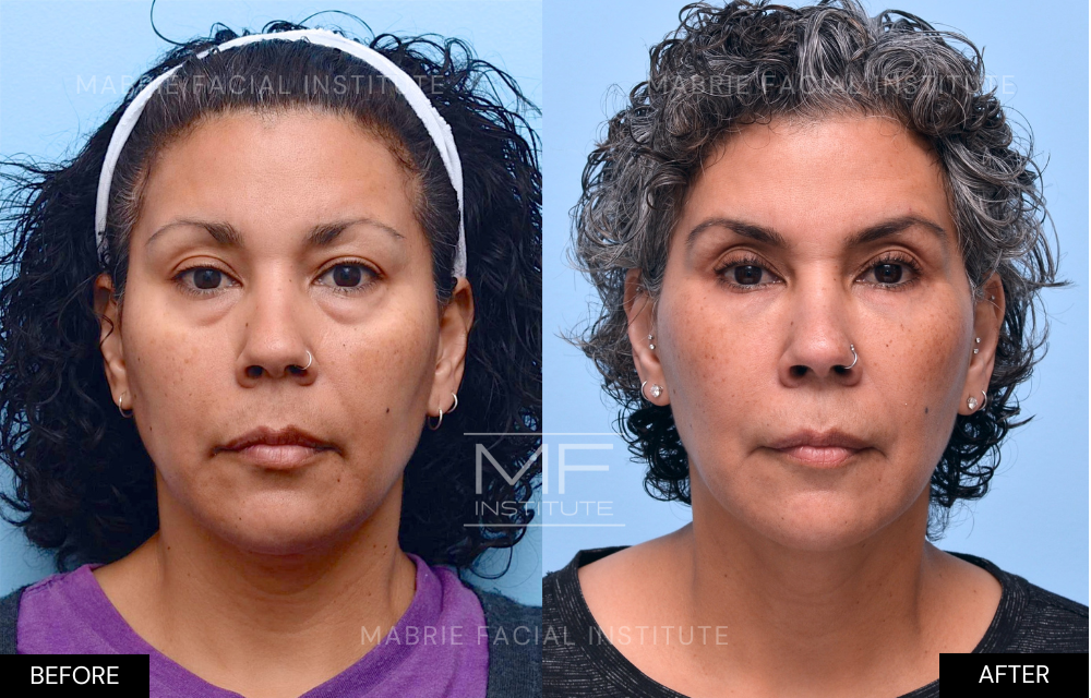 Before and after tear trough filler results over 4 years Case #849