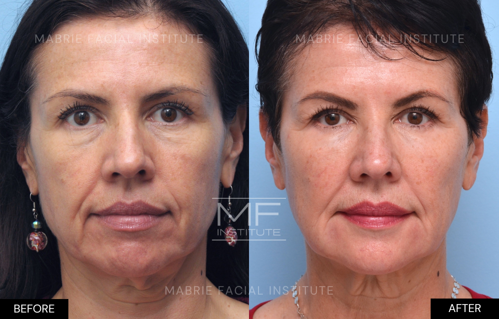 Before and after results of tear trough filler over 10 years case #988