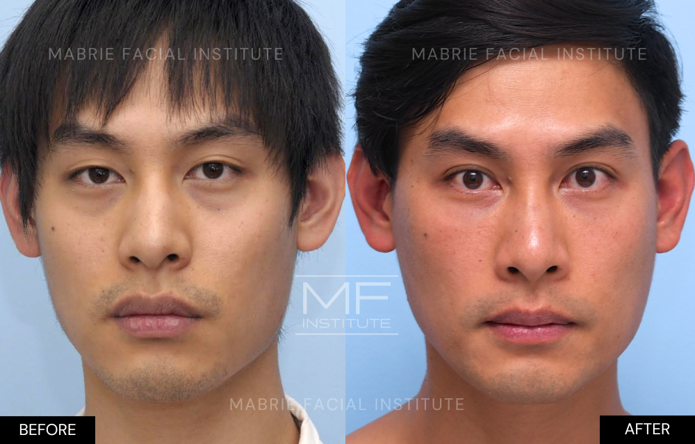 Before and after tear trough filler results over 9 years case #296