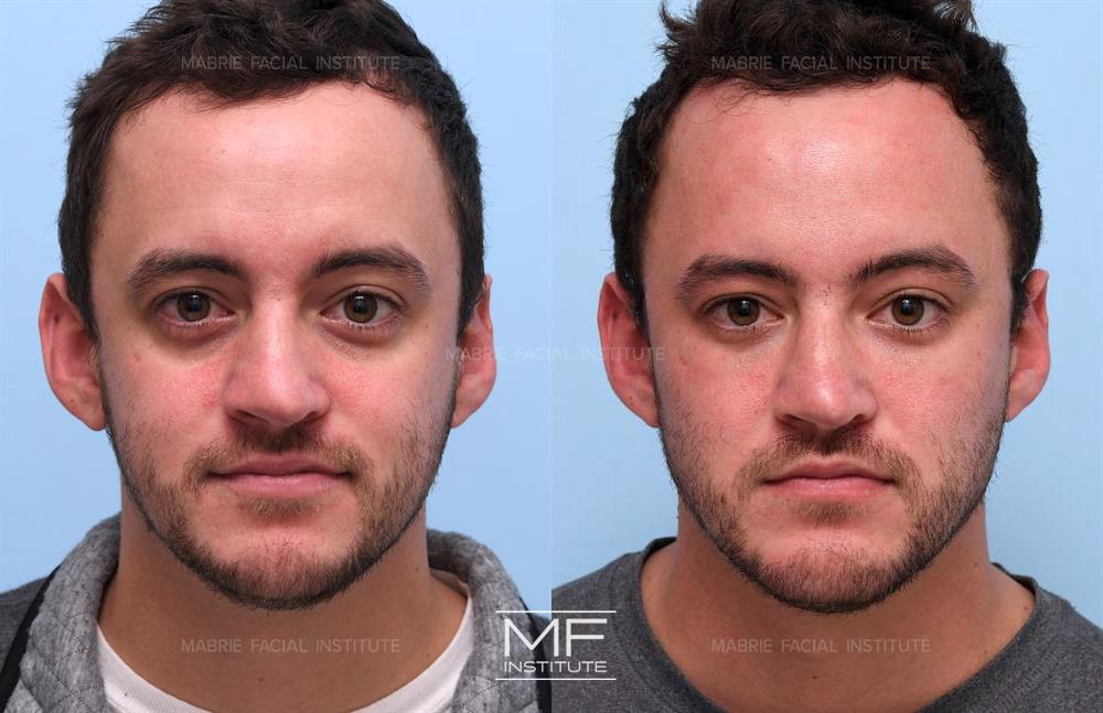 before and after under eye filler for men in San Francisco at Mabrie Facial Institute