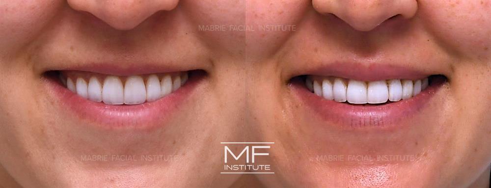 Before and after neuromodulator injections for a "lip flip" at MFI in San Francisco case #864