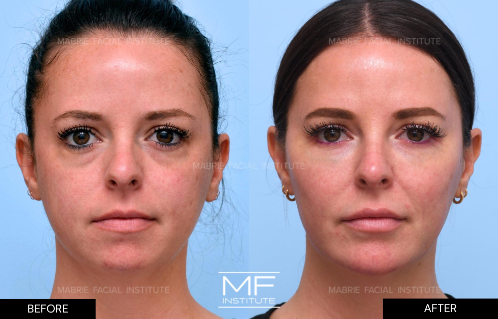 Before and after dermal filler results case #434