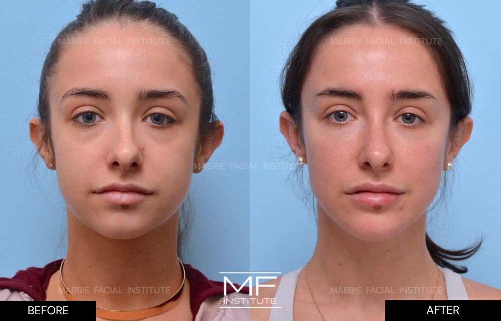 Before and after under eye filler results case #1255