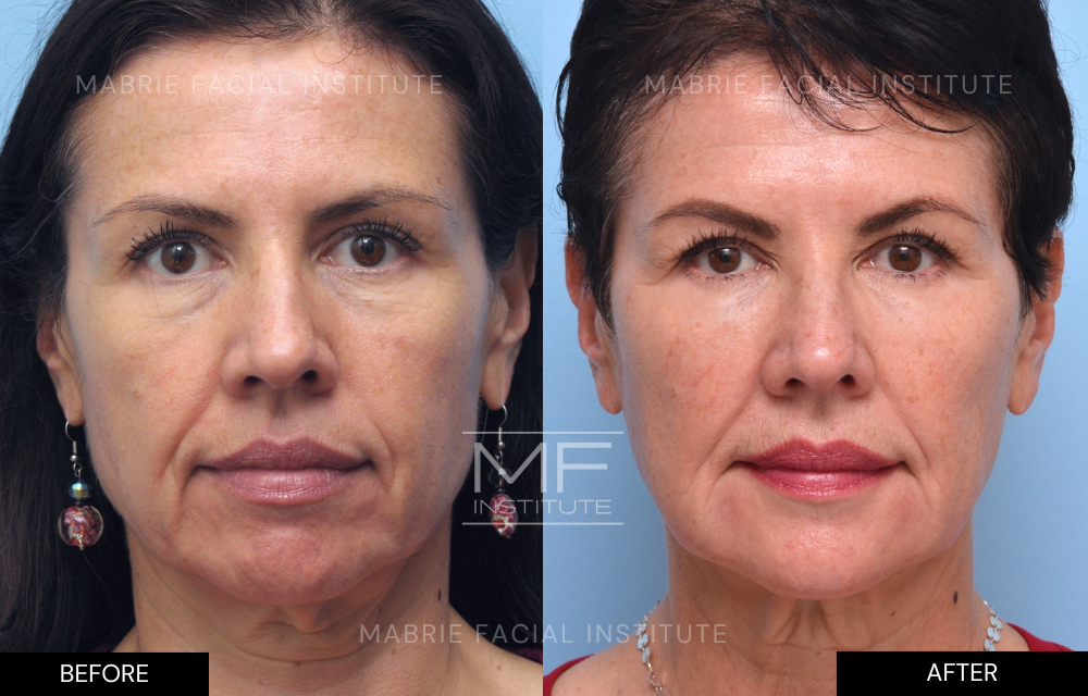 Before and after complete facial rejuvenation case #448