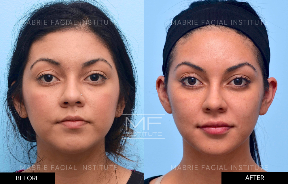 Before and after complete facial rejuvenation case #415