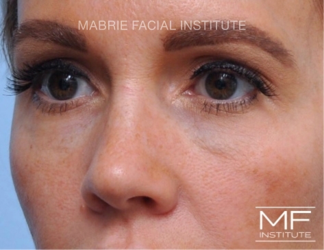 before fillers dissolved