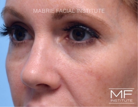 after fillers dissolved