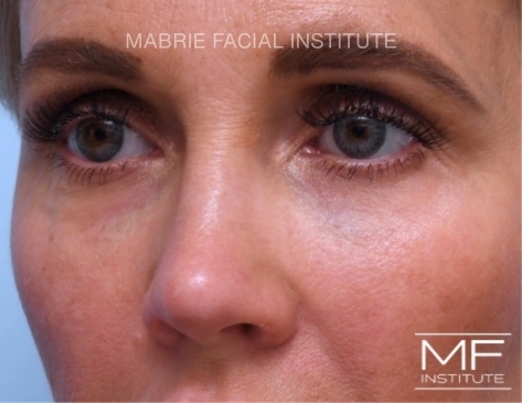 woman with new fillers