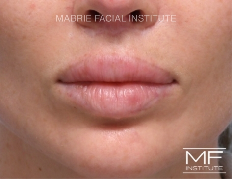 after filler dissolved