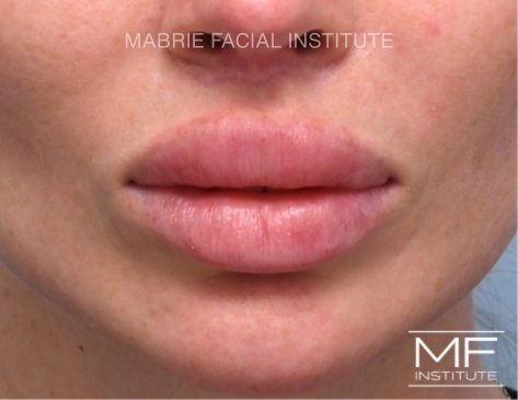 before filler dissolved