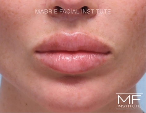 lips with new filler