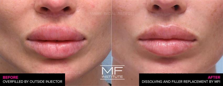 Before & After contouring for Dissolving Lip Filler face shape