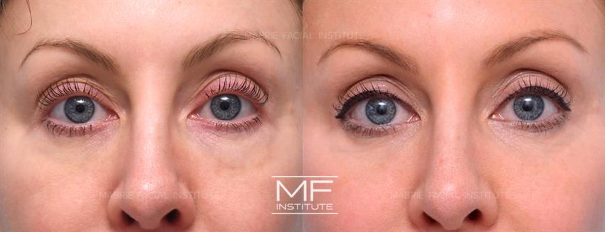 Before & After contouring for Dissolving Filler Under the Eyes face shape