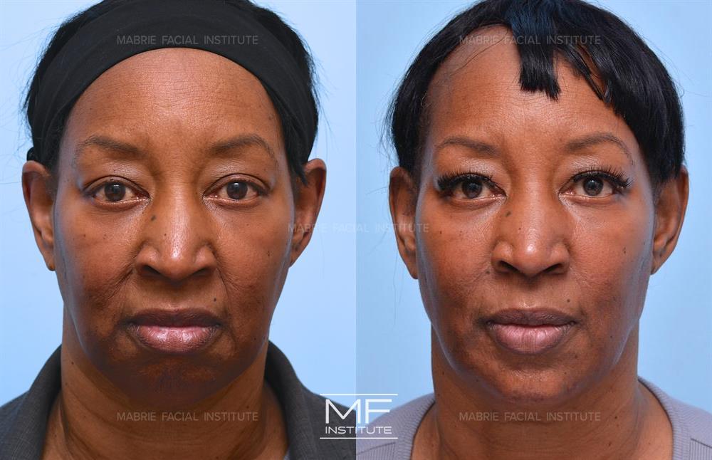 Before and After BOTOX & Filler for Nasolabial Folds case #1154