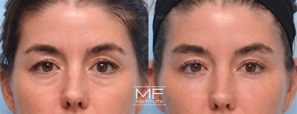 Before and after neuromodulator injections for a subtle brow lift at MFI in San Francisco case #1166