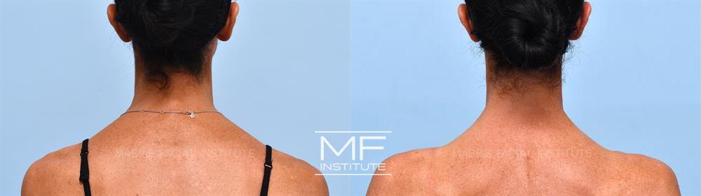 Before and after neuromodulator injections to reduce the bulk of the shoulders (trap tox, Barbie BOTOX) at MFI in San Francisco case #1191