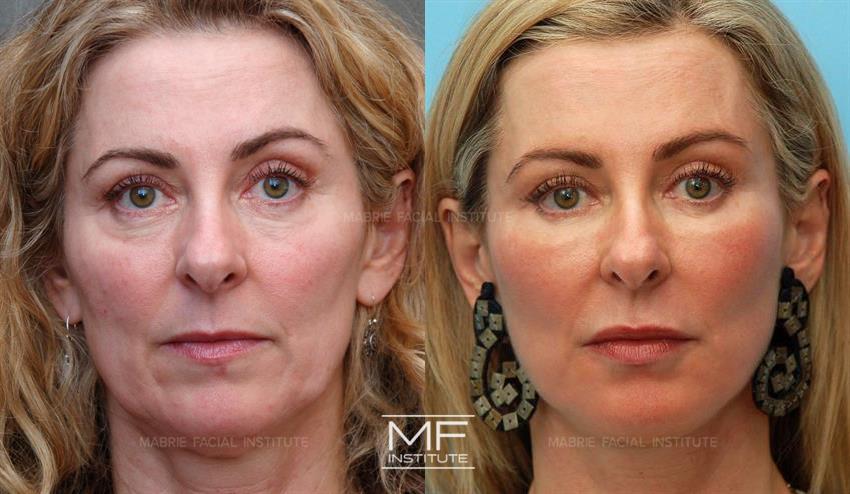 Before & After contouring for Our Early Filler Patients face shape