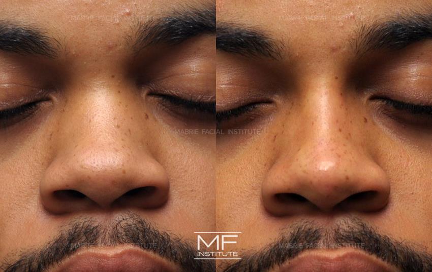 Before & After contouring for nose-wide face shape