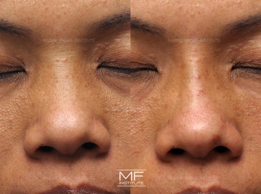 Before & After contouring for nose-wide face shape