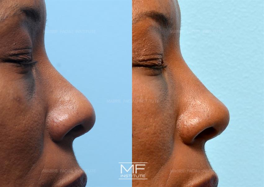 Before & After contouring for MFI Real Non Surgical Rhinoplasty Results face shape