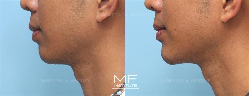 Before & After contouring for Jaw Angle face shape