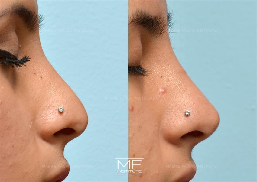 Before & After contouring for nose-droppy-tip face shape