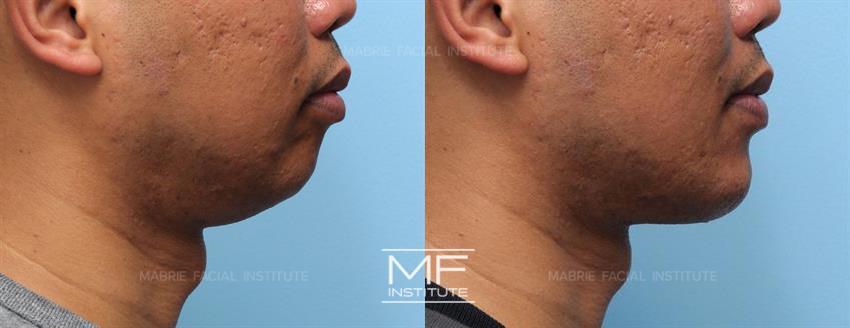 Before & After contouring for Chin & Jaw Filler for Men face shape