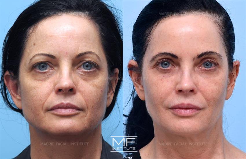 Before & After contouring for Our Early Filler Patients face shape
