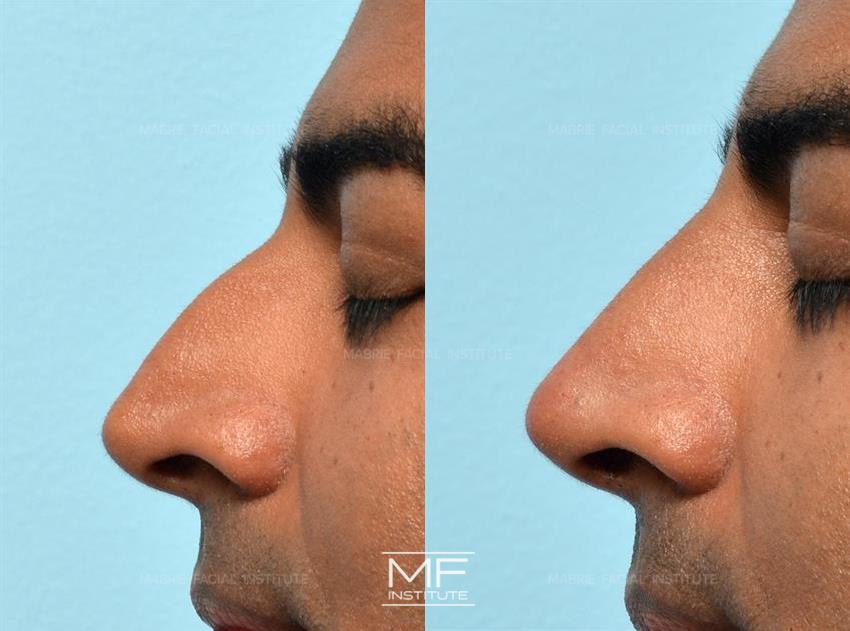 Before & After contouring for Non Surgical Nose Job for Men face shape
