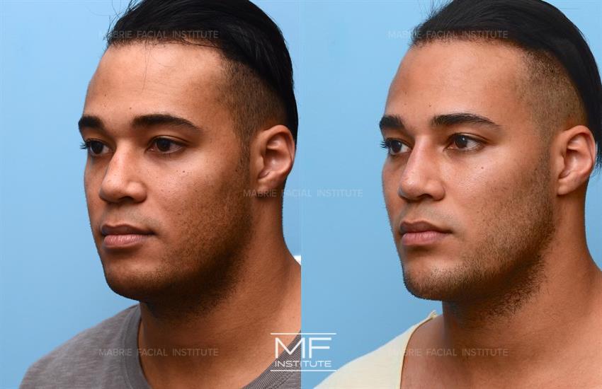 Before & After contouring for oval face shape