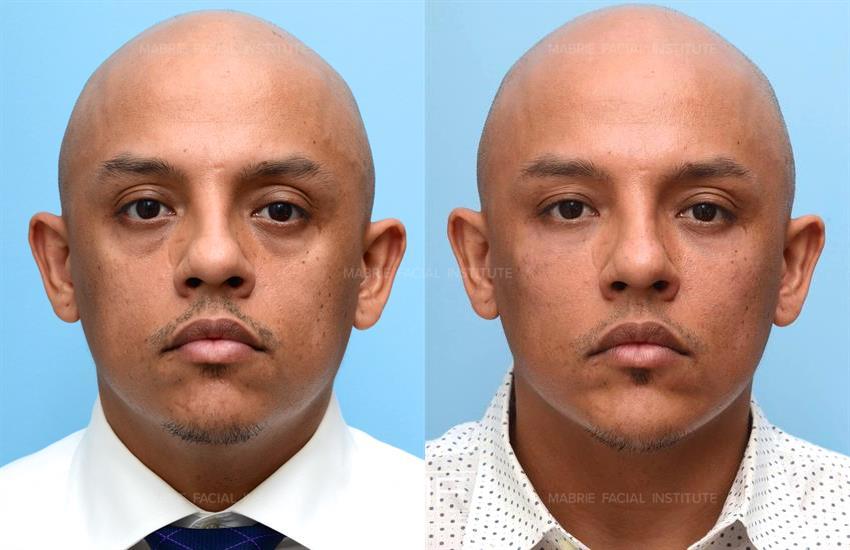 Before & After contouring for Under Eye Filler for Men face shape