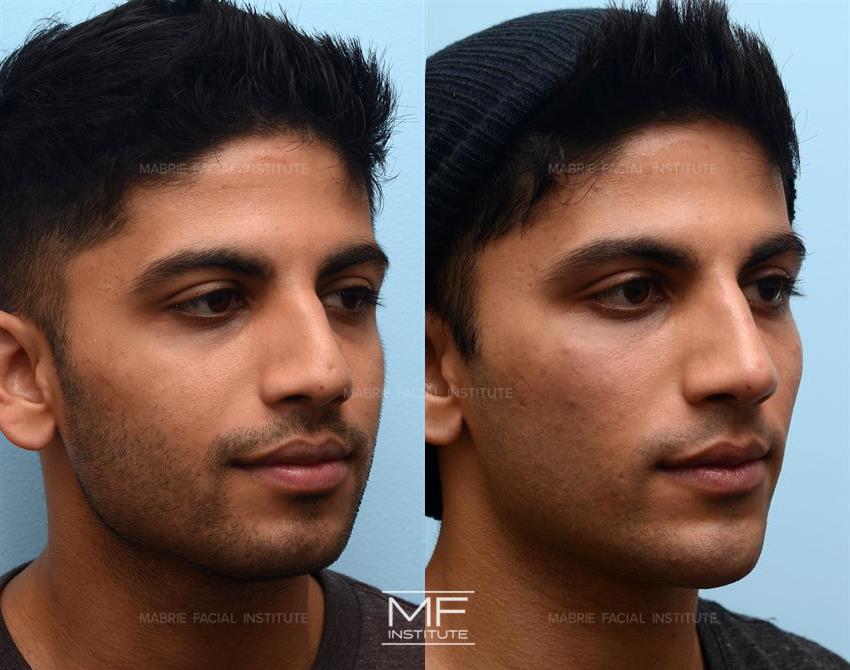 Non-Surgical Jawline Contouring - An Alternative to Facial Implants