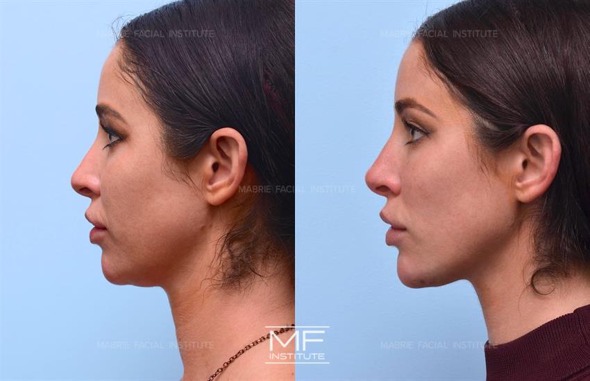 Full Face Contouring Before & After Photo Gallery, San Francisco, CA