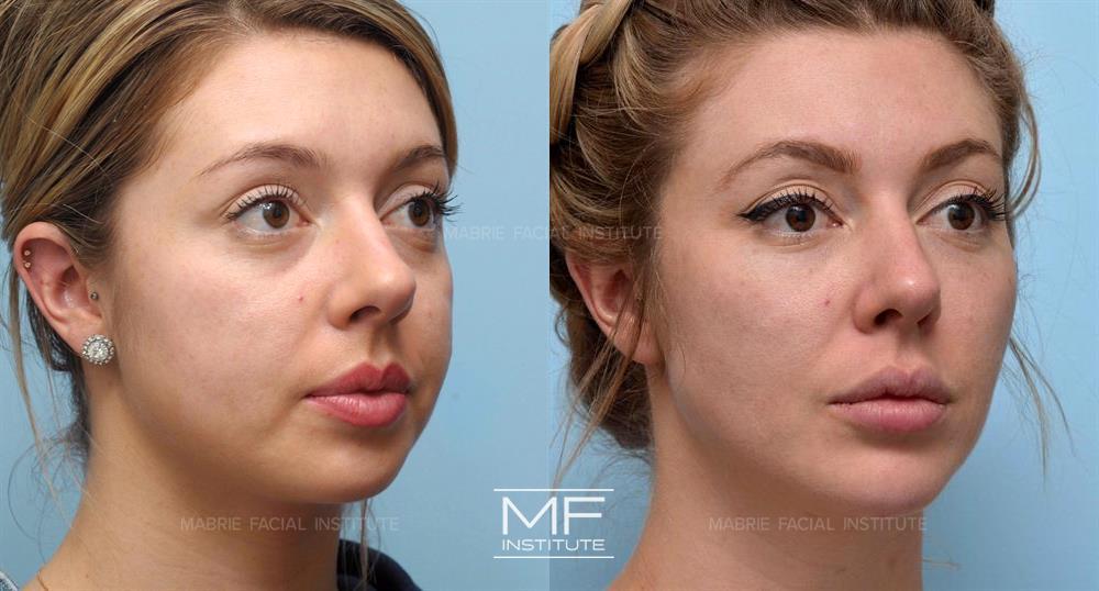 From full cheeks to refined contours— this patient's dream of a chiseled  face/jaw was made a reality!🤩 Dr. Murphy performed a cheek…