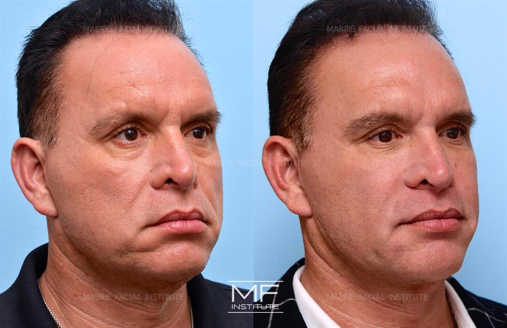 Before and After BOTOX & Fillers To Address Jowls case #433